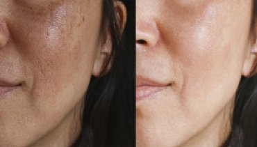 Take advantage of Dr. Amita Bharti's professional Melasma treatment at Reshapeyou clinic in Patna