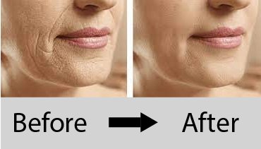 At Reshapeyou Clinic in Patna, Dr. Amita Bharti offers advanced wrinkle treatment.